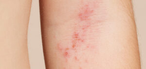 Cuidados generales de la piel en pacientes con Dermatitis Atópica