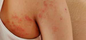 Afecciones de la Piel en niños con Infección por el Virus de Inmunodeficiencia Humana Adquirida.